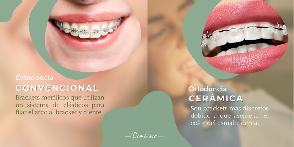 Brackets convencionales ortodoncia convencional ortodoncia ceramica