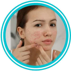 acné_facial_piel_tratamiento_salud_belleza_estética_bienestar